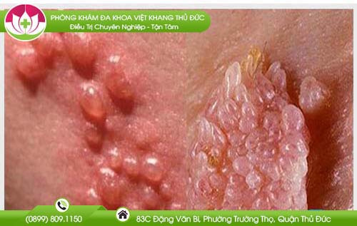noi-hot-o-vung-kin-nu