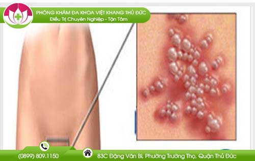 Bị nổi hột ở vùng kín nữ là dấu hiệu của bệnh gì?