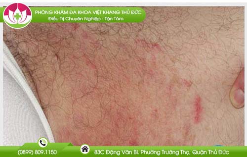 Bị nổi mẩn đỏ ngứa ở háng nam giới có sao không?