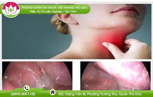 nuoc-mui-chay-xuong-hong