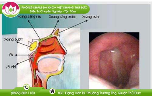 nuoc-mui-chay-xuong-hong