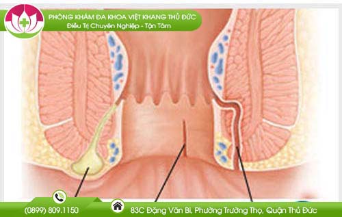 Nứt hậu môn cấp là như thế nào