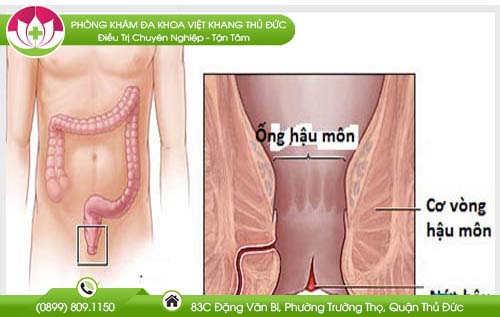 Nứt hậu môn chảy máu là bị bệnh gì?