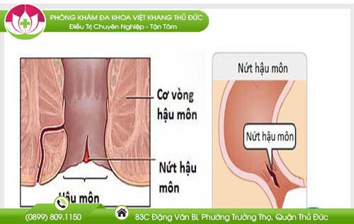 Nứt hậu môn chữa như thế nào