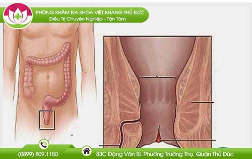 Nứt hậu môn phải làm sao?