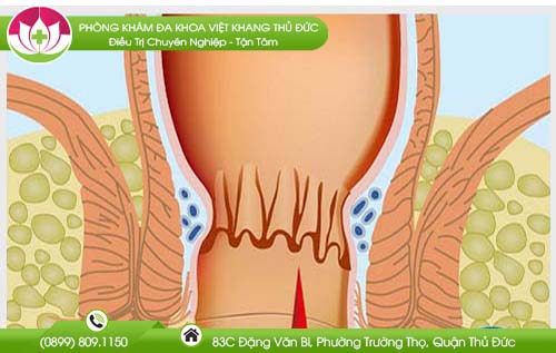 Nứt kẽ hậu môn bao lâu thì khỏi?