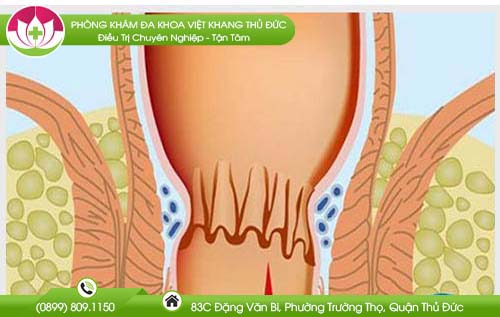 Nứt kẽ hậu môn chảy máu