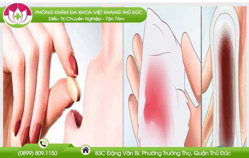 Phá thai bằng thuốc ra máu bao nhiêu ngày