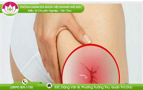 Phẫu thuật nứt hậu môn bao nhiêu tiền?