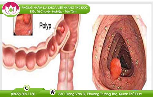 phuong-phap-dot-noi-soi-de-dieu-tri-polyp-hau-mon-co-hieu-qua-khong