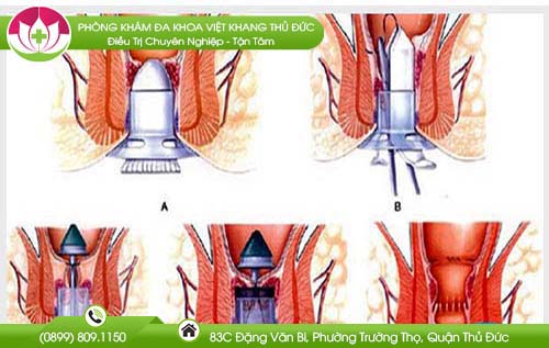 Phương pháp morgan trị bệnh trĩ có còn hiệu quả?