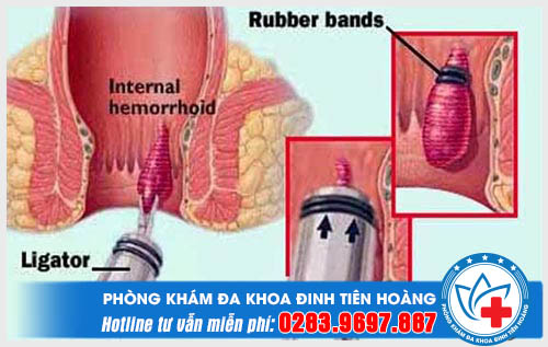 Phương pháp thắt búi trĩ bằng vòng cao su là như thế nào?