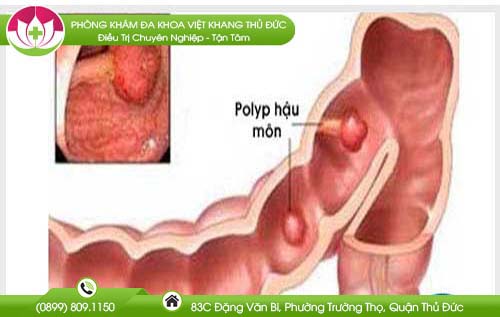 Polyp hậu môn có phải là trĩ và có nên cắt polyp hậu môn không?