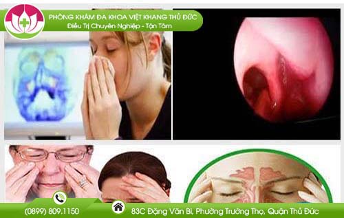 Polyp xoang hàm và những nguy hiểm khôn lường – Chăm sóc sức khỏe