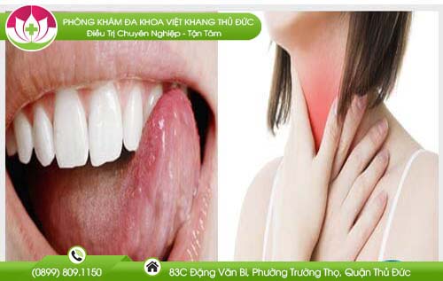 Bị rát lưỡi đau họng là bệnh gì và cách chữa trị hiệu quả