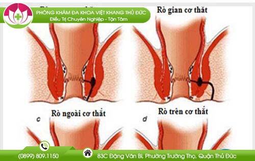 Rò hậu môn có nguy hiểm không?