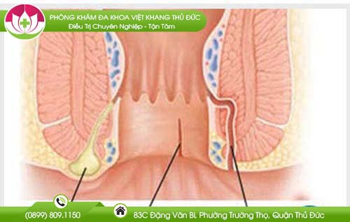 Rò hậu môn có tái phát không?