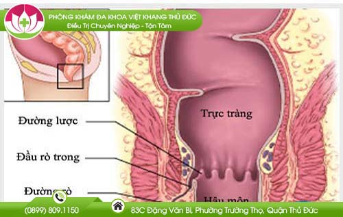 Rò hậu môn tái phát