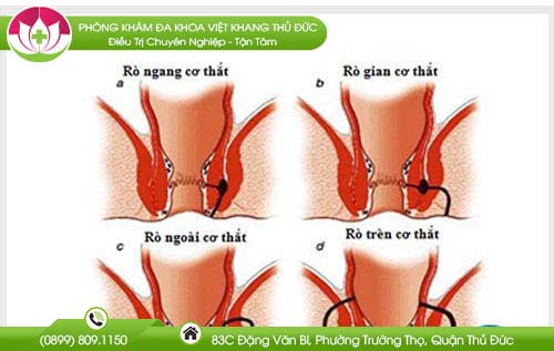 Rò hậu môn xuyên cơ thắt