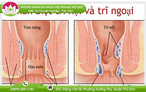 Sự khác nhau giữa trĩ nội và trĩ ngoại