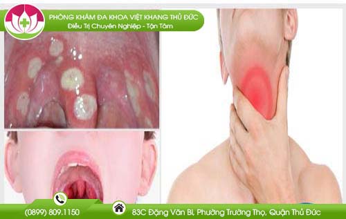 Tìm hiểu nguyên nhân sưng lưỡi gà và cách điều trị nhanh chóng