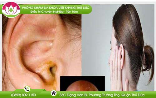 Tai chảy nước vàng là bệnh gì và chữa trị ở đâu hiệu quả?