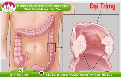 Táo bón kéo dài là con đường dẫn đến bệnh ung thư đại tràng