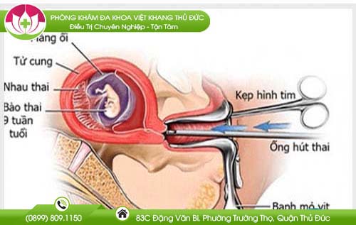 thai-10-tuan-co-pha-duoc-khong