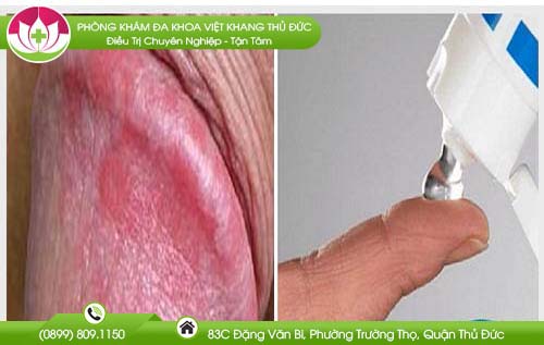 thuoc-boi-tri-ngua-bao-quy-dau