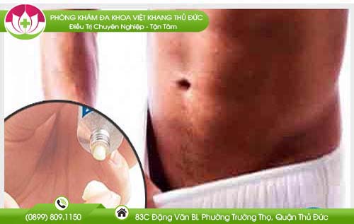 Sử dụng thuốc bôi trị ngứa bao quy đầu, nên hay không?