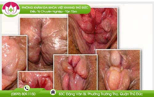 tong-hop-cac-hinh-anh-benh-tri-cac-loai-va-dau-hieu-nhan-biet