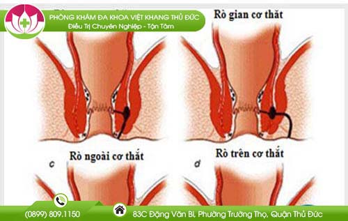 tong-hop-nhung-hinh-anh-ro-hau-mon-pho-bien-nhat