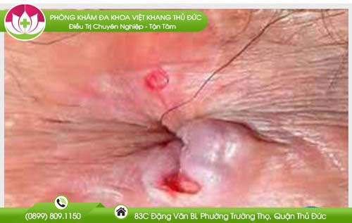 tong-hop-nhung-hinh-anh-ro-hau-mon-pho-bien-nhat