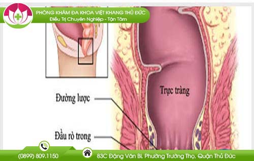 Tổng hợp những hình ảnh rò hậu môn phổ biến nhất