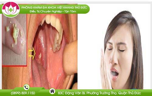 tonsil-stones-la-gi