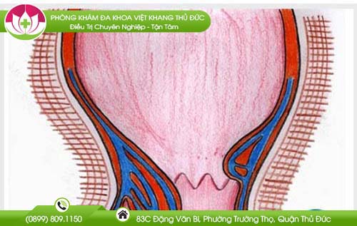 Trĩ chảy máu nhiều phải làm sao?