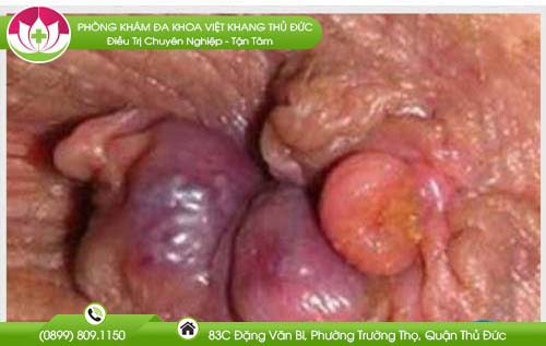 tri-ngoai-do-3-la-nhu-the-nao