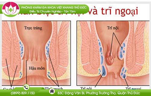 Trĩ nội hay trĩ ngoại nguy hiểm hơn?
