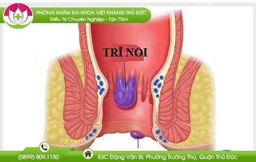 Trĩ nội và trĩ ngoại cái nào nặng hơn?
