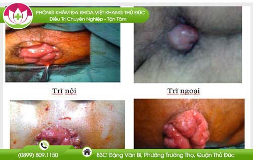 tri-vong-la-gi-nguyen-nhan-dau-hieu-va-cach-dieu-tri