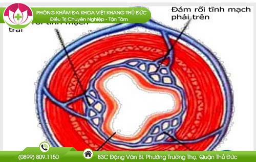Trĩ vòng là gì? Nguyên nhân, dấu hiệu và cách điều trị