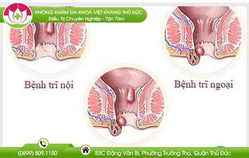 Triệu chứng bệnh trĩ giai đoạn cuối và cách điều trị