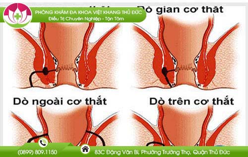 trieu-chung-ro-hau-mon