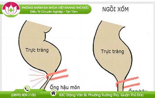 Tư thế ngồi vệ sinh đúng cách