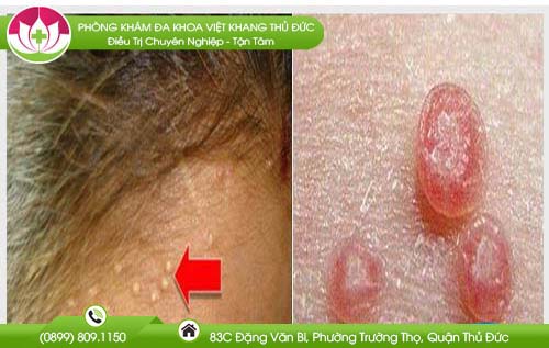 U mềm lây ở mặt chữa trị như thế nào để mang lại hiệu quả tốt nhất