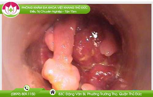 U nhú phì đại vùng hậu môn là gì?