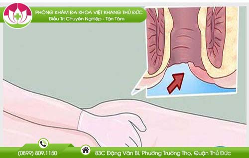 Ung thư hậu môn là gì, có chết không?