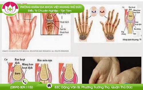 Bệnh viêm khớp dạng thấp là gì? Nguyên nhân và biểu hiện