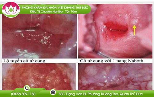 Cách Phòng Ngừa Viêm Quanh Lỗ Cổ Tử Cung