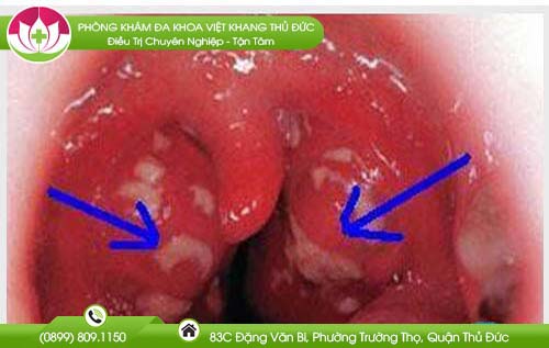 vom-hong-co-dom-trang